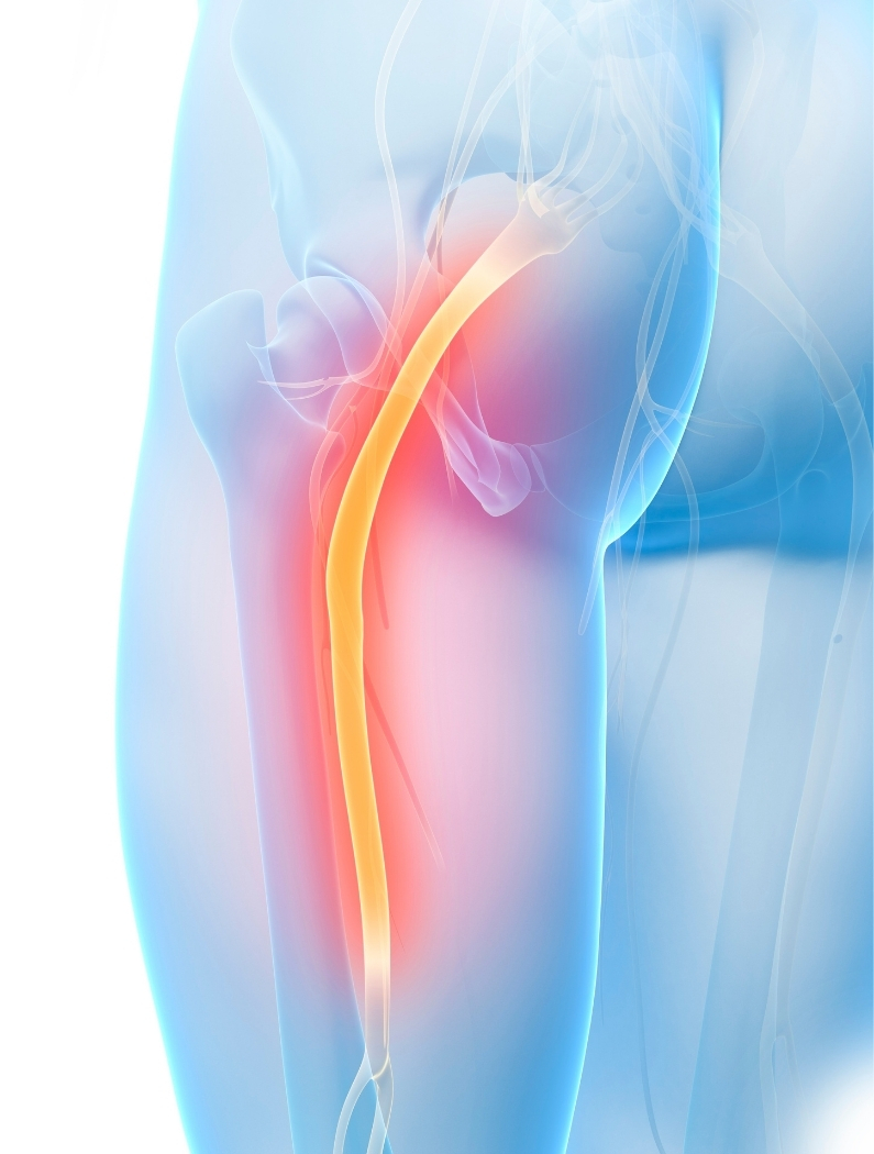 Dolor irradiado hacia la pierna asociado a ciática