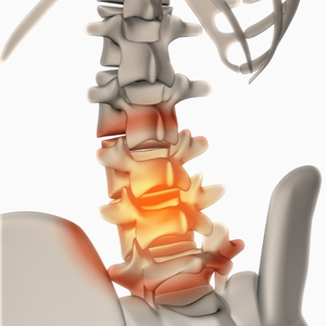 Hernia discal lumbar y cervical - tratamiento quiropráctico y fisioterapia en Dolorfin